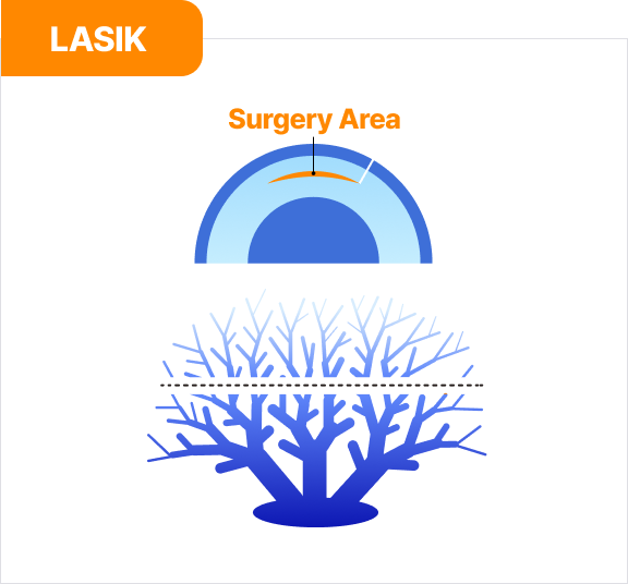 라식 | LASIK