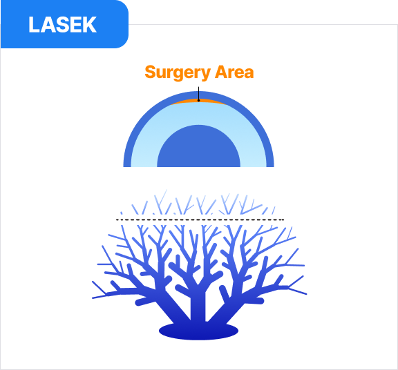 라섹 | LASEK