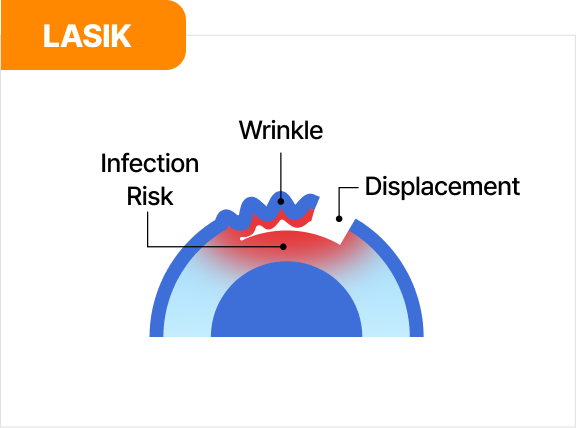 라식 | LASIK
